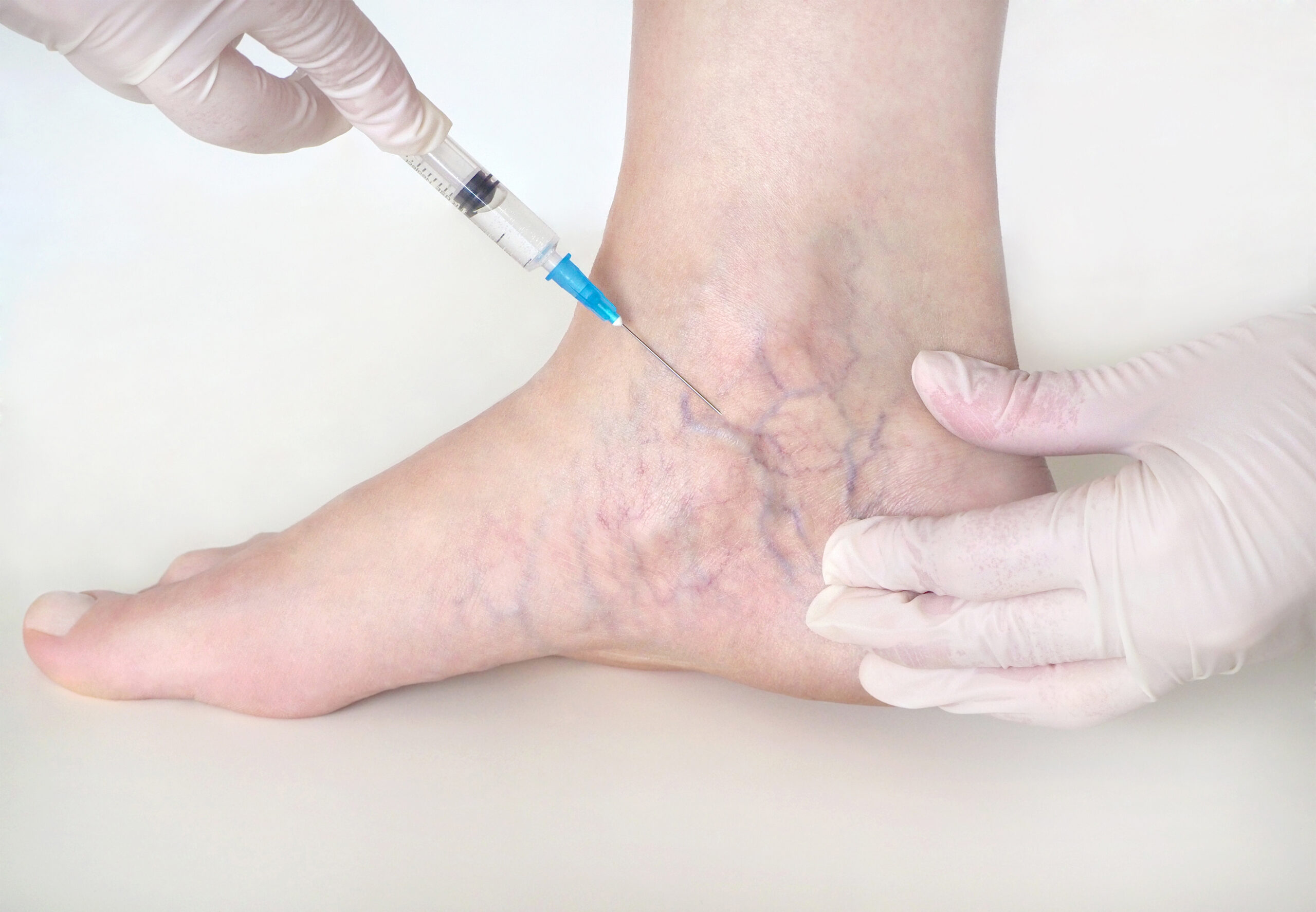 Sclerotherapy injections for spider and varicose veins