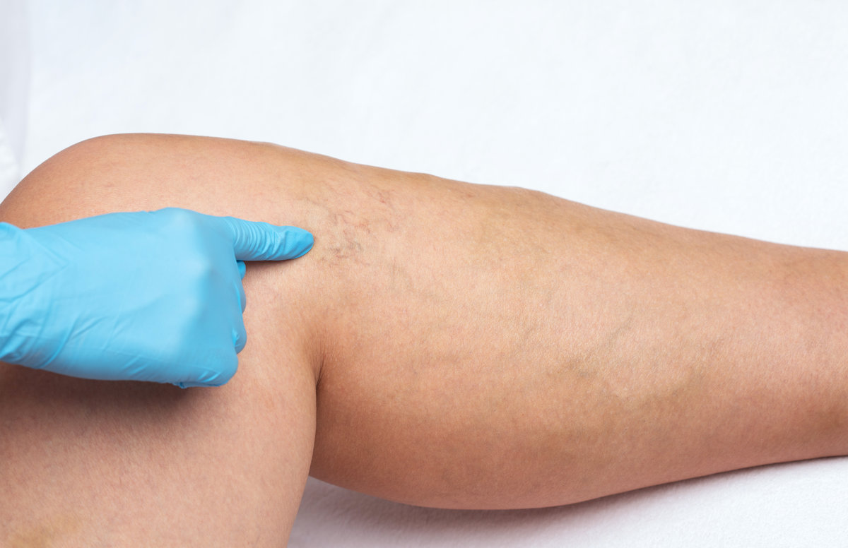 Removal of varicose veins on the legs. Medical inspection and treatment of Telangiectasia. Phlebeurysm.