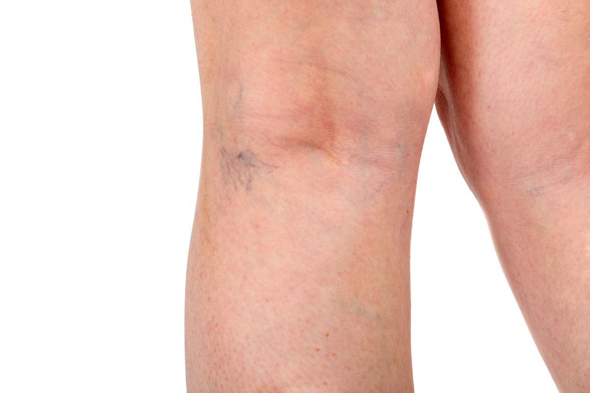 Close up of the beginning of varicose veins below the knee showing visible swollen veins illustrating venous insufficiency and vascular condition for medical and health concepts