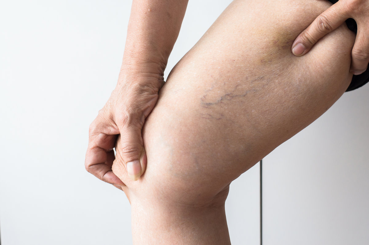 Varicose veins on the elderly asian woman leg,Close up