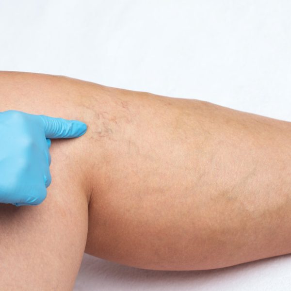 Removal of varicose veins on the legs. Medical inspection and treatment of Telangiectasia. Phlebeurysm.