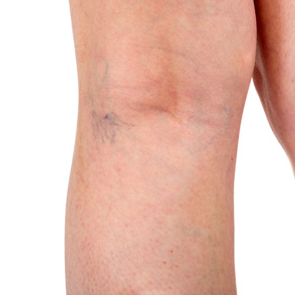 Close up of the beginning of varicose veins below the knee showing visible swollen veins illustrating venous insufficiency and vascular condition for medical and health concepts