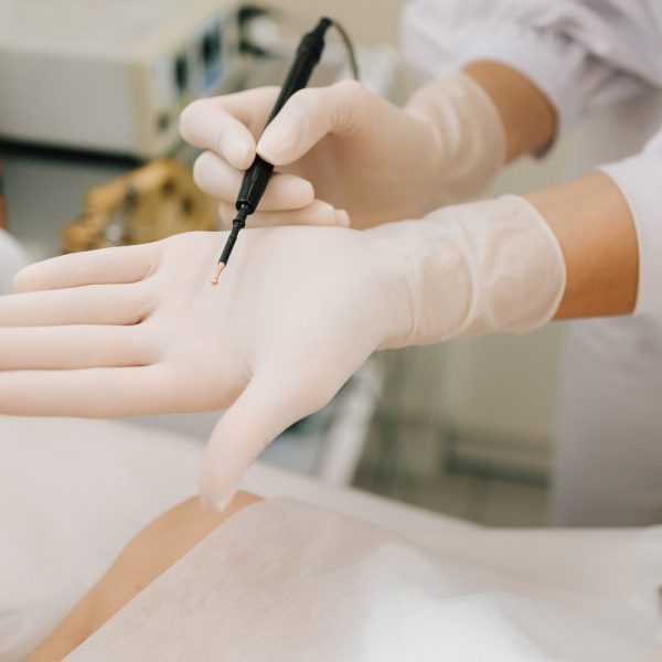 Radiofrequency mole removal under clinical conditions. dermatologist performs precise radio wave mole removal using radiofrequency surgery. Close-up of radio wave dermatologic mole excision