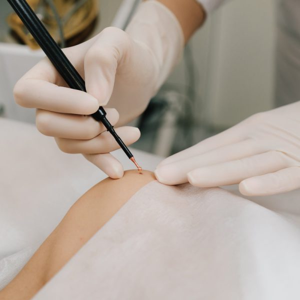 Dermatologist performs precise radio wave mole removal using radiofrequency surgery. Close-up of radio wave dermatologic mole excision. Radiofrequency mole removal under clinical conditions