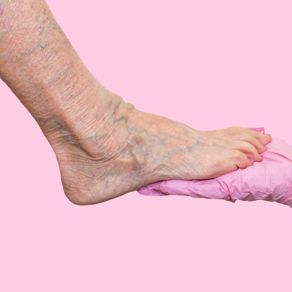 Lower limb vascular examination because suspect of venous insufficiency. The female legs on pink background