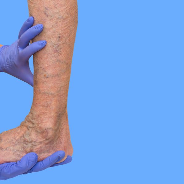 Lower limb vascular examination because suspect of venous insufficiency. The female legs on blue background