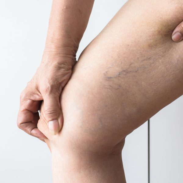 Varicose veins on the elderly asian woman leg,Close up