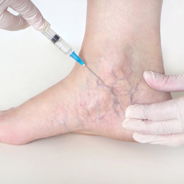 Sclerotherapy injections for spider and varicose veins