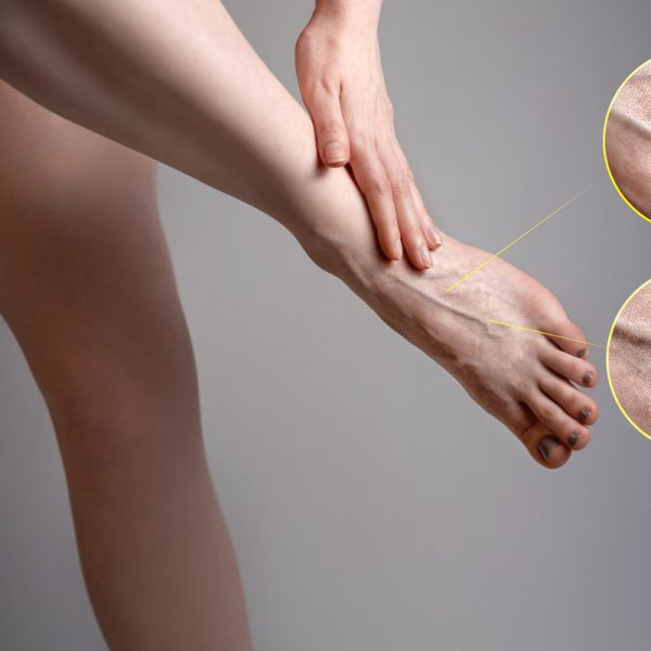 A young woman holds her hands to her foot. Fatigue and heaviness in the legs. The concept of varicose veins. Images with magnification of diseased vessels.