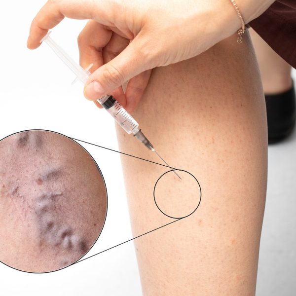Woman making injection with syringe in leg skin with varicose vein close up