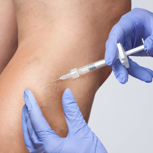 A doctor does medical procedure Sclerotherapy used to eliminate varicose veins and spider veins. An injection of a solution directly into the vein.