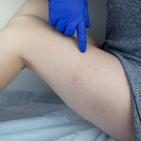 A vascular surgeon examines a leg with varicose veins. Vascular network and blood vessels are shown close-up through a magnifying glass. Preparation for laser treatment and sclerotherapy