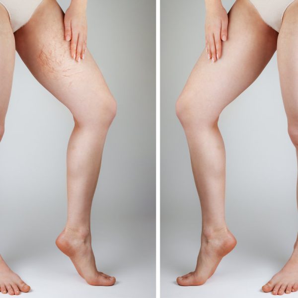 The concept of varicose veins and cosmetic treatment. The woman points to the vascular asterisks on the inner surface of the thigh. Legs close up. Gray background. Before and after concept.