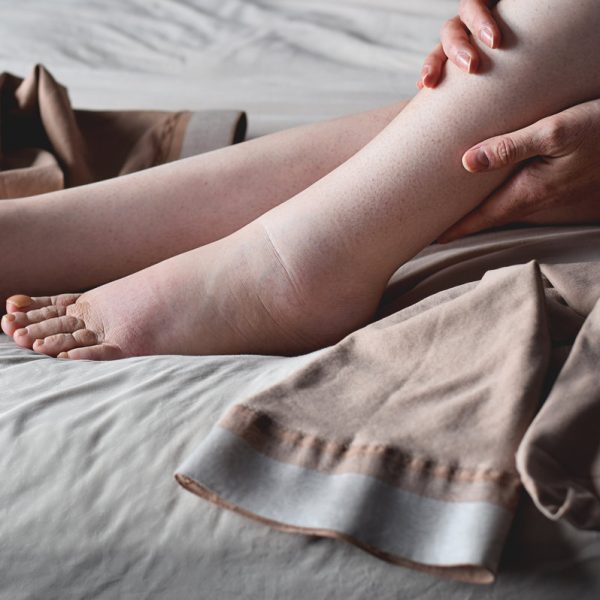 Woman putting on compression stockings on swollen feet affected by lymphedema condition