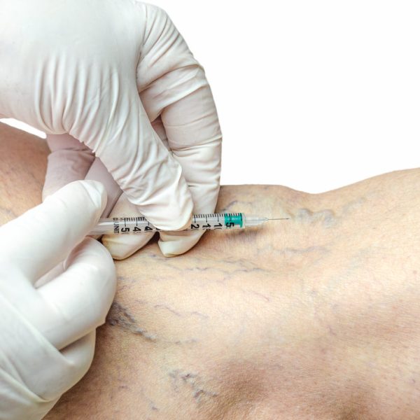 Sclerotherapy on the legs of an adult Caucasian male. Removal of varicose veins with injection by a doctor in white gloves. Atrophied veins from smoking. Telangiectasias. Venous thrombosis.