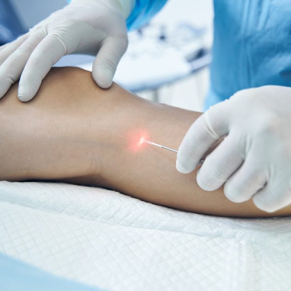 Leg of the patient on the operating table. Hands in latex gloves putting laser fiber under the skin