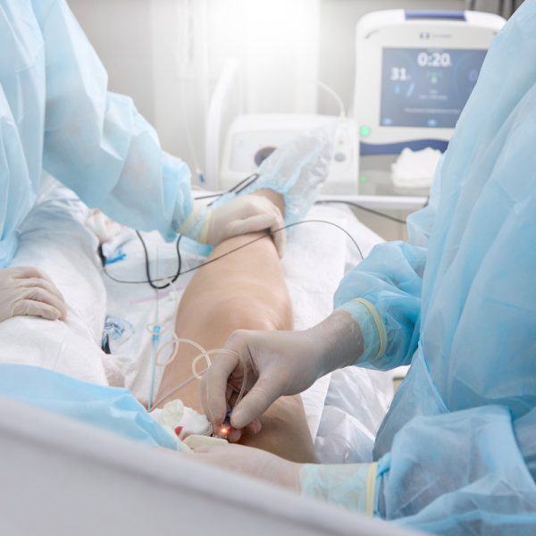 Surgical treatment varicose veins in hospital by team vascular surgeons by Radiofrequency ablation. Surgeon in operating room inserts catheter into vein on patient's lower limb treat varicose veins